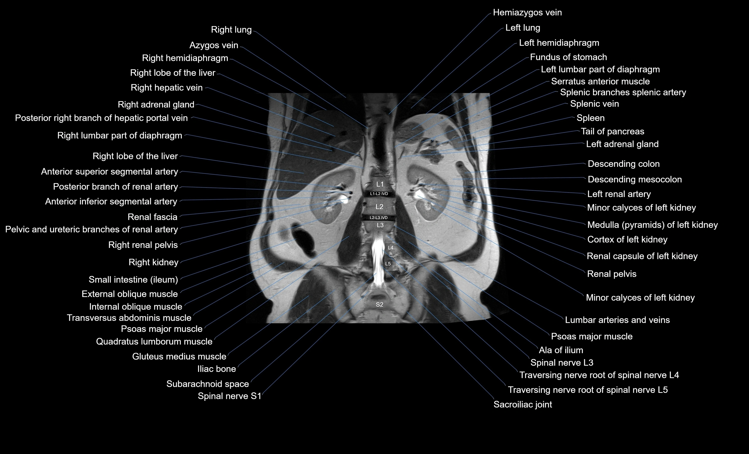 MRI Abdomen coronal labelled cross sectional anatomy radiology  image-img-00001-00039.webp